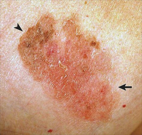 skin spots under breasts melanoma
